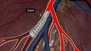 Whats a stent [upl. by Adnolohs]