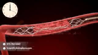 Mechanical Thrombectomy  Neurovascular stent deployment [upl. by Enajiram633]