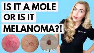 Is It A Mole or Melanoma This Might Save Your Life  Dermatologist Tips [upl. by Oehsen]