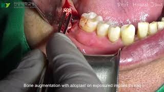 Surgical Regenerative Treatment of PeriImplantitis with TiBrush [upl. by Firestone803]