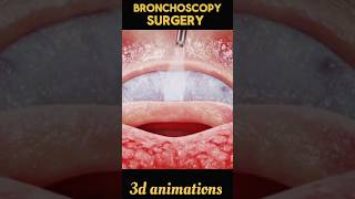 Bronchoscopy Surgery process viral shorts bronchoscopy 3d [upl. by Dino501]