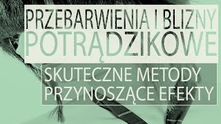 Przebarwienia i blizny potrądzikowe [upl. by Radnaskela]