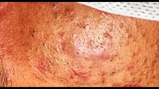 how to remove acne Blackheads and whiteheads it stay with him 5 years ago  Lymy nature 4 [upl. by Tem]