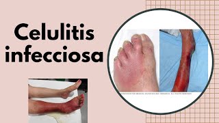 ERISIPELA y CELULITIS INFECCIOSA ¿ES CONTAGIOSA ¿Qué secuelas deja la celulitis que debo hacer [upl. by Jacy]