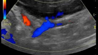 portosystemic shunt through R gastric vein in a dog [upl. by Nairoc]