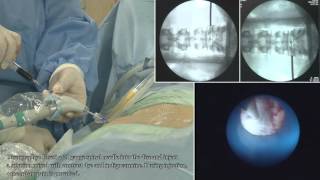 II TELA  Transforaminal Epiduroscopic Laser Annuloplasty   full procedure [upl. by Grier]