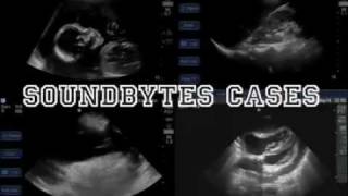 How To Abdominal Ultrasound  Aorta Case Study Video [upl. by Huntlee217]