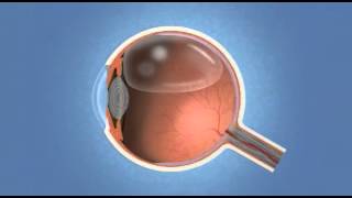 Vitrectomy  Eye Associates of Colorado Springs [upl. by Ahsilahk]