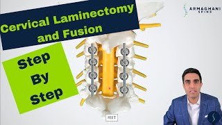 Posterior Cervical Laminectomy and Fusion  Procedure details recovery and expectations [upl. by Yklam]