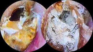 Thick fungus dry earwax removal asmrearwax 22 [upl. by Schonfield]