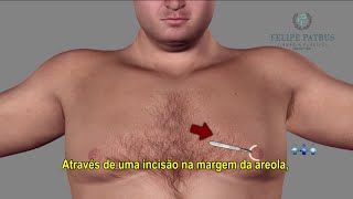 GINECOMASTIA  CIRURGIA PLÁSTICA DA MAMA MASCULINA  DR FELIPE PATRUS [upl. by Nyladgam721]