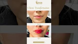 💋Client Transformation Lip Filler Before amp After💋  Swan Aesthetic Clinic [upl. by Aehc]