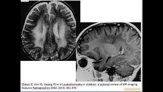 49 Metachromatic leukodystrophy MLD arylsulfatase A deficiency lysosomal tigroid pattern [upl. by Madelon]