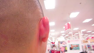 Swollen Ear From Wasp Sting  Daily Vlog 327  July 9th 2016 [upl. by Bambie]