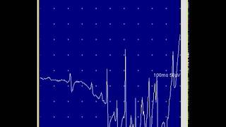 V2  EMG Online Series Myotonic Discharge triggered by needle movement [upl. by Sidell856]