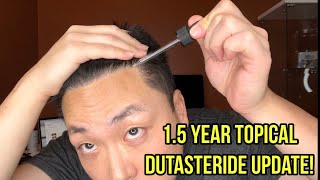 TOPICAL DUTASTERIDE UPDATE AFTER 15 YEARS [upl. by Tammany740]