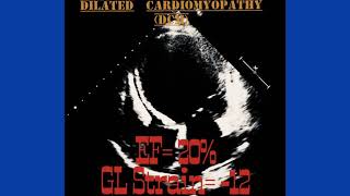 Dilated Cardiomyopathy Echocardiography [upl. by Fritzsche]