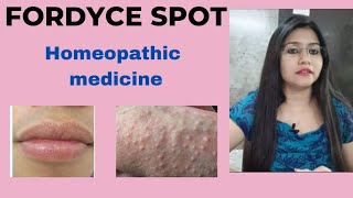 Fordyce Spots White Bumps  Symptoms Causes Treatments  Fordyce spots Homeopathic medicine [upl. by Waldos]