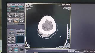 Scalp Heamatoma on CT Brain [upl. by Urquhart]