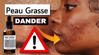 3 CONSEILS POUR PEAU GRASSE [upl. by Yeldnarb288]