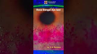 Rose Bengal Dye Test Superficial Punctate Keratitis [upl. by Bouton]