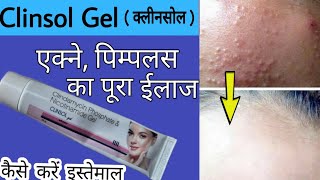 Clinsol Gel Review In Hindi  एक्ने पिम्पलस ऑयली स्किन की असरदार दवा [upl. by Rebliw]