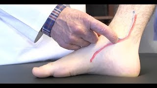 How to diagnose Posterior Tibial Tendonitis [upl. by Moonier]