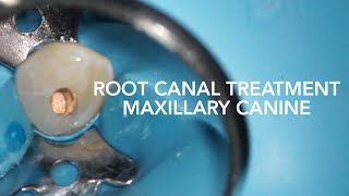 Root Canal Treatment on Maxillary Canine Tooth 23 [upl. by Dewar]