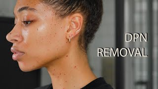 Dermatosis Papulosa Nigra DPN Removal [upl. by Croteau457]