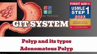 USMLE Step1 Polyp and its types Adenomatous Polyps from first aid step 1USMLEUrduHindi [upl. by Alokin]