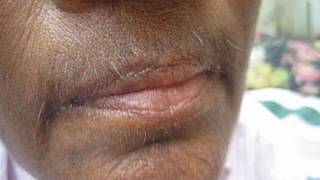 Female Facial Hairs Treatment [upl. by Wyler]