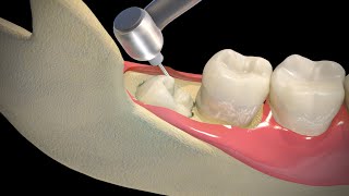 Wisdom Teeth Extraction  Step by step [upl. by Martica]