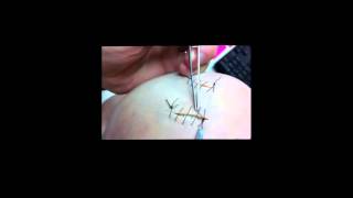 Removing a Running Suture  Final [upl. by Nishi]