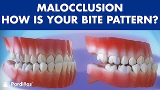 Malocclusion  Bite patterns © [upl. by Selyn]