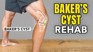 Bakers Cyst Treatment Rehab Exercises [upl. by Ttreve922]