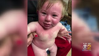 Child Has Anaphylactic Reaction To Paint With DairyBased Ingredients [upl. by Rubie]