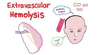 Extravascular Hemolysis [upl. by Faxun]