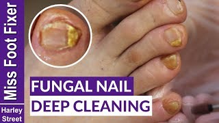 HOW TO GET RID OF FUNGAL INFECTION ON NAILS BY MISS FOOT FIXER MARION YAU [upl. by Eldreeda]