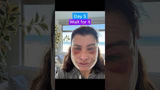 EPIC FACELIFT TRANSFORMATION Journey [upl. by Seth]