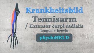 physioHELD Tennisarm  Epicondylitis humeri lateralis  Extensor carpi radialis longus  brevis [upl. by Godderd]