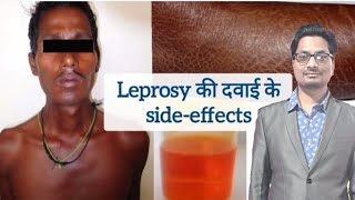 Leprosy की दवाइयों के sideeffects  Dapsone  Clofazimine  Rifampicin  Hansens disease leprosy [upl. by Lotsyrk]