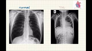 Tetralogy of fallot xray explanation l med by Abrar شرح بالعربي [upl. by Blaine]