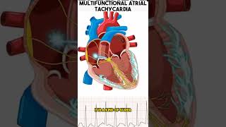 Heart related problems  Multifocal Atrial Tachycardia anatomy heartproblems shorts [upl. by Milks515]