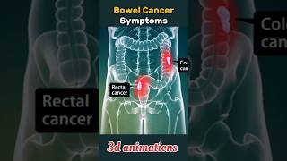 bowelcolorectal cancer symptoms shorts rectal bowel cancer [upl. by Ainalem]