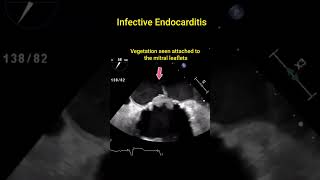 Infective Endocarditis [upl. by Nilyam]