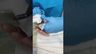 World Biggest BOT FLY Removal From Finger OMG😱 huge bot fly on girl  botfly botflyremoval [upl. by Dripps830]