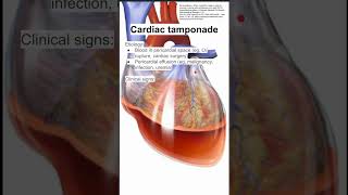 Oncologic Emergencies Cardiac Tamponade [upl. by Ayaet365]