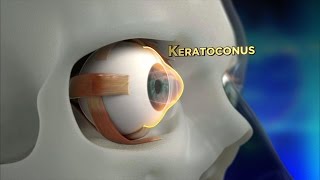 Keratoconus Procedure Explained [upl. by Lyrehs]