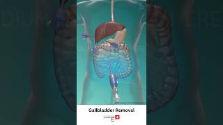 Gallbladder Removal Surgery ↪ 3D Medical Animation Shorts Gallbladder [upl. by Seko]