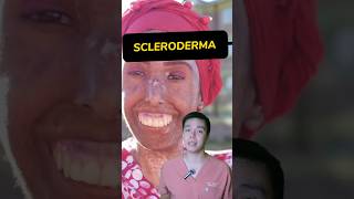 How to operate SCLERODERMA surgeonph viralvideo viralshorts fyp foryou foryoupage scleroderma [upl. by Park]